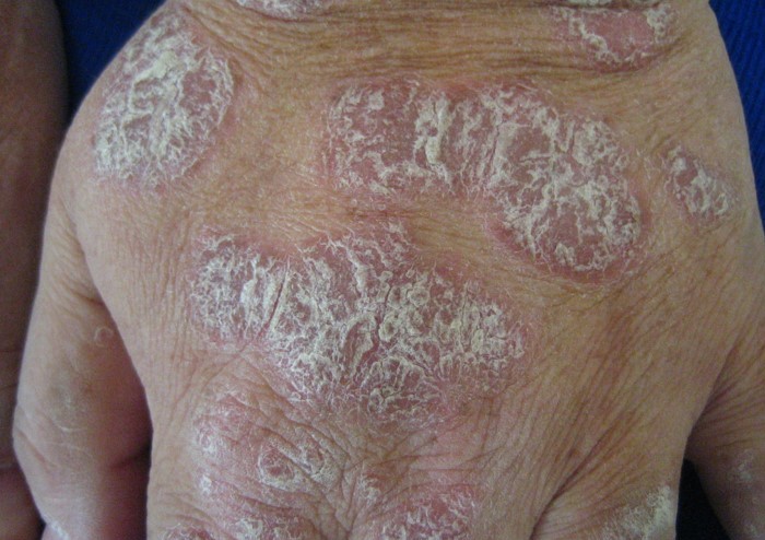 Psoriasis 