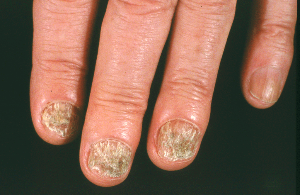 Nail Infection