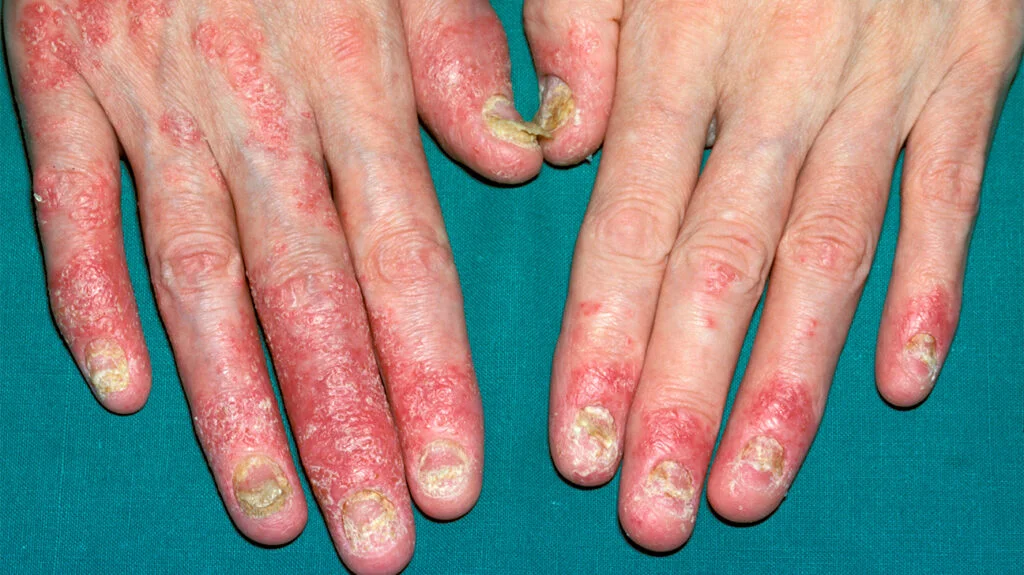 Psoriatic arthritis